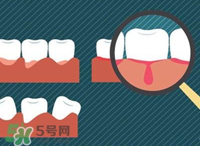 牙齦出血是什么原因？牙齦出血怎么回事