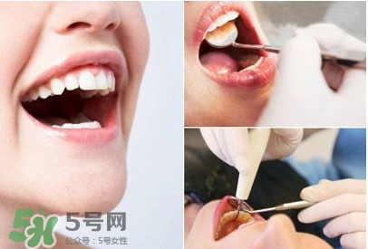 如何去掉牙結石？牙結石怎么去除