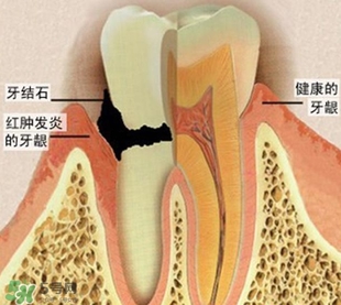 牙結(jié)石是什么？牙結(jié)石圖片