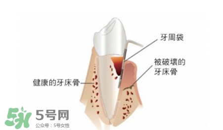 牙周炎怎么治療？牙周炎怎么治好