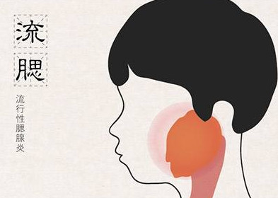 流行性腮腺炎有哪些癥狀？流行性腮腺炎的癥狀