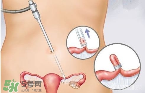 女人怎樣避孕最安全？對女人最好的避孕方法