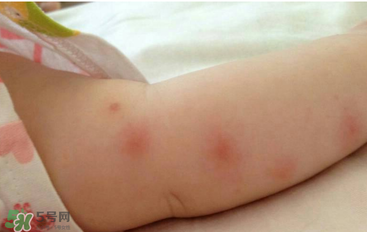 嬰兒蚊子咬了怎么消腫？嬰兒蚊子咬了怎么消腫止癢最快？