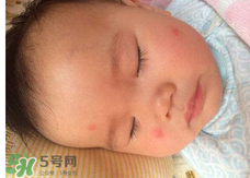 嬰兒蚊子咬了怎么消腫？嬰兒蚊子咬了怎么消腫止癢最快？