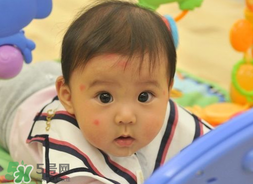 嬰兒被蚊子咬了如何去紅點(diǎn)？被蚊子咬后紅點(diǎn)如何去除？