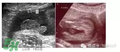 B超單數(shù)據(jù)怎么看男女？B超單看男女準(zhǔn)嗎？