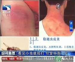 隱翅蟲有毒嗎？隱翅蟲會(huì)毀容嗎？