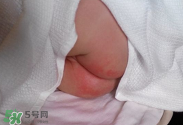 尿布疹怎么辦？寶寶尿布疹擦什么藥好？