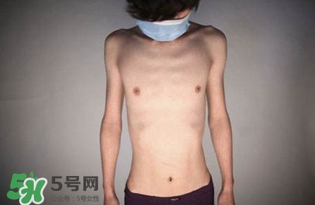 HIV真有這么可怕嗎？艾滋病的臨床表現(xiàn)主要有哪些