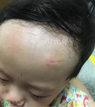 日本msd祛疤膏是抗生素嗎？日本msd祛疤膏是不是抗生素？