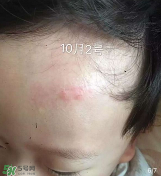 日本msd祛疤膏是抗生素嗎？日本msd祛疤膏是不是抗生素？