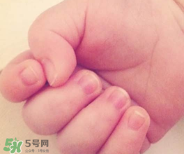 寶寶指甲凹凸不平是什么原因？寶寶指甲凹凸不平正常嗎？