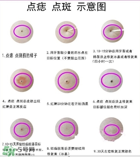 藥水點(diǎn)痣和激光點(diǎn)痣哪個(gè)好？各有什么優(yōu)缺點(diǎn)