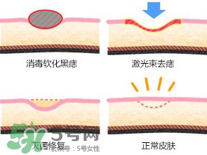 藥水點(diǎn)痣和激光點(diǎn)痣哪個(gè)好？各有什么優(yōu)缺點(diǎn)