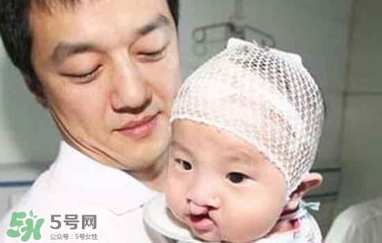 兔唇是什么？兔唇是什么原因造成的？