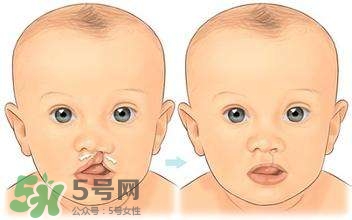 兔唇能檢查出來(lái)嗎？兔唇能完全修復(fù)嗎？