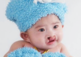 兔唇可以治嗎？兔唇修補術(shù)