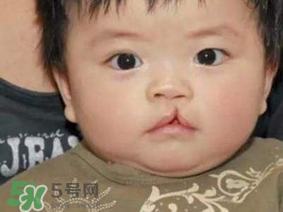 兔唇可以治嗎？兔唇修補術(shù)