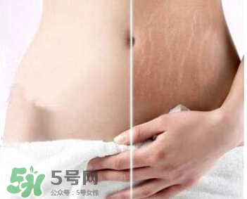 妊娠紋怎么長在大腿上了？妊娠紋會不會長在大腿上？
