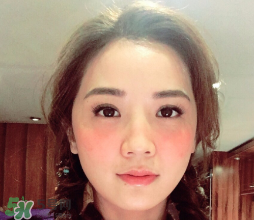 夏天可以點(diǎn)痣嗎？夏天點(diǎn)痣后要注意什么？