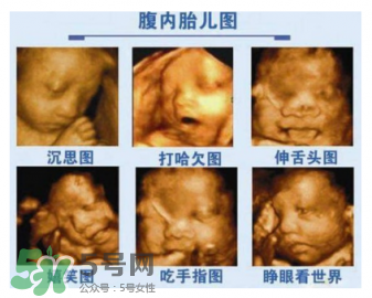 四維彩超有必要做嗎？四維彩超檢查不出什么？
