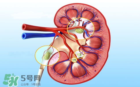 腎結(jié)石有什么癥狀？腎結(jié)石原因
