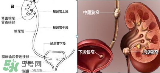 腎結(jié)石怎么治最好？腎結(jié)石的醫(yī)治方法