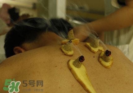 三伏灸有用嗎？2017年三伏艾灸時間