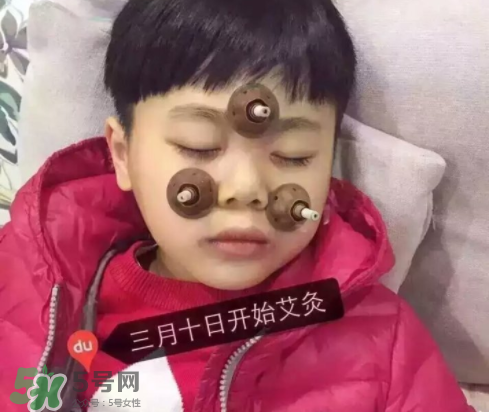 艾灸貼可以治咳嗽嗎？艾灸貼可以治退燒嗎？