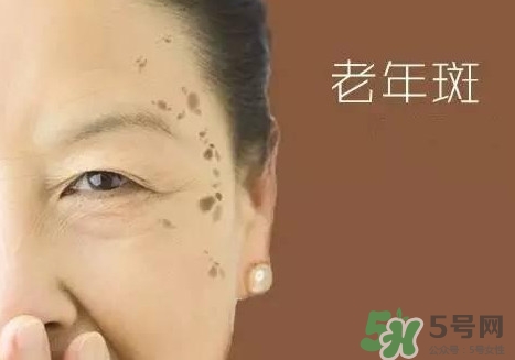 老年斑多大年齡開始有？為什么牙膏能去老年斑？