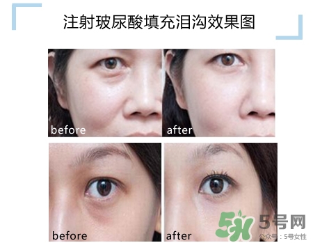 玻尿酸填充淚溝多久恢復(fù)自然？玻尿酸填充淚溝的危害