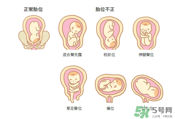 胎位不正如何矯正？胎位不正一定要剖腹產(chǎn)嗎？