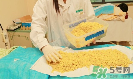 隔姜灸效果怎么樣？隔姜灸好還是直接灸好