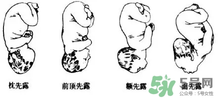 胎位不正能順產(chǎn)嗎？胎位不正怎么辦？