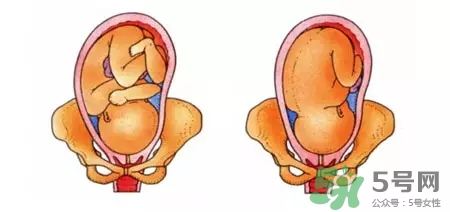 胎位不正能順產(chǎn)嗎？胎位不正怎么辦？