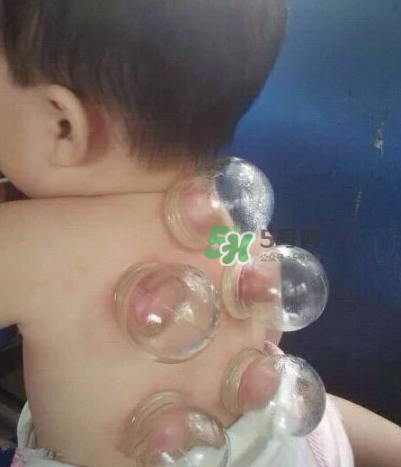 拔火罐后顏色多久消失？拔火罐印子多久能消除？