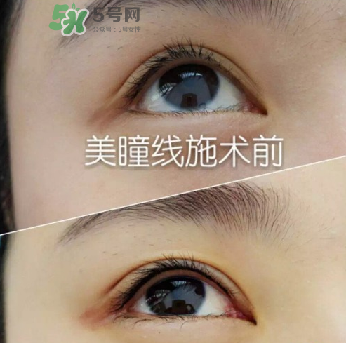 做美瞳線可以吃雞蛋嗎？做美瞳線能吃雞蛋嗎？