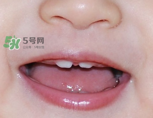 牙齒縫隙大怎么辦？牙縫大帶牙套有用嗎