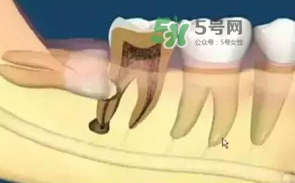 智齒是每個人都會長嗎？拔智齒能瘦臉嗎？