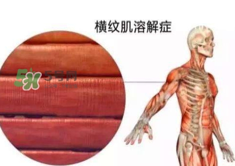 橫紋肌溶解癥會死亡嗎？橫紋肌溶解癥能活多久