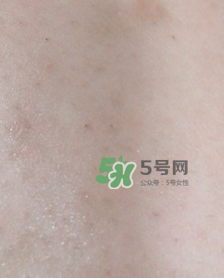 Dermatix舒痕疤痕膏有效嗎？Dermatix舒痕疤痕膏怎么用？