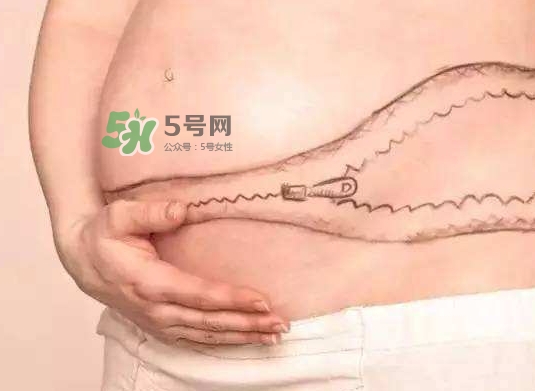 剖腹產(chǎn)疤痕怎么去除？剖腹產(chǎn)疤痕能去掉嗎？