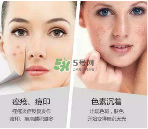 果酸換膚自己可以做嗎？果酸換膚后注意事項(xiàng)
