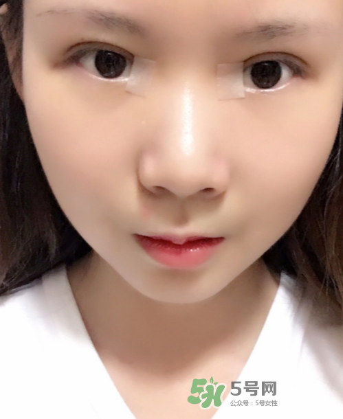 美皮護(hù)去疤效果怎么樣？美皮護(hù)有用嗎？