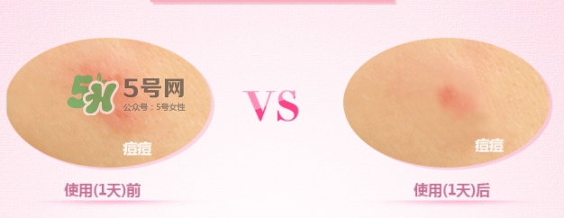 3m痘痘貼怎么用？3m痘痘貼貼多久？