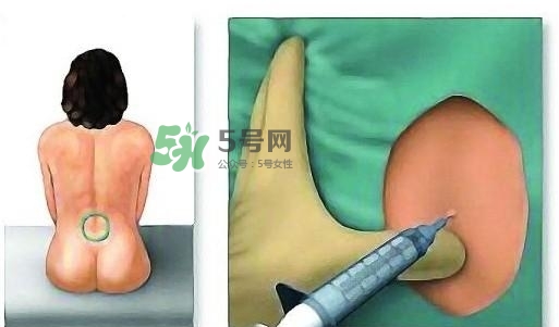 無痛分娩為什么不提倡？無痛分娩有后遺癥嗎？