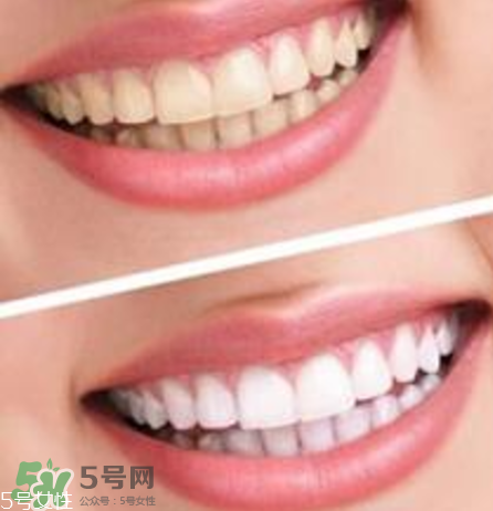 碧緹福美牙儀對(duì)牙齒有傷害嗎？碧緹福美牙儀會(huì)反彈嗎？