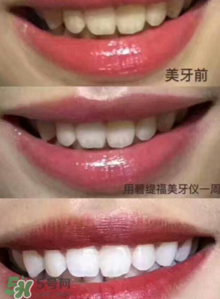 美牙儀能用水洗嗎？美牙儀能用多久？