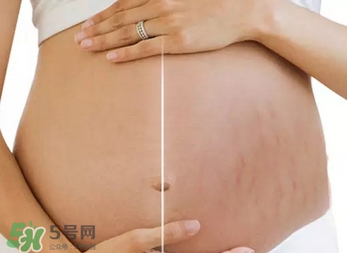 脖子上會長妊娠紋嗎？妊娠紋長在哪些地方？
