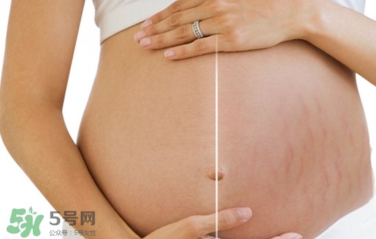 妊娠紋在左邊生男或女？怎么從妊娠紋看男女？
